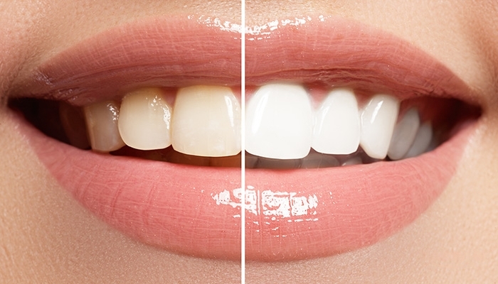 5 Simple Ways to Naturally Whiten Your Teeth